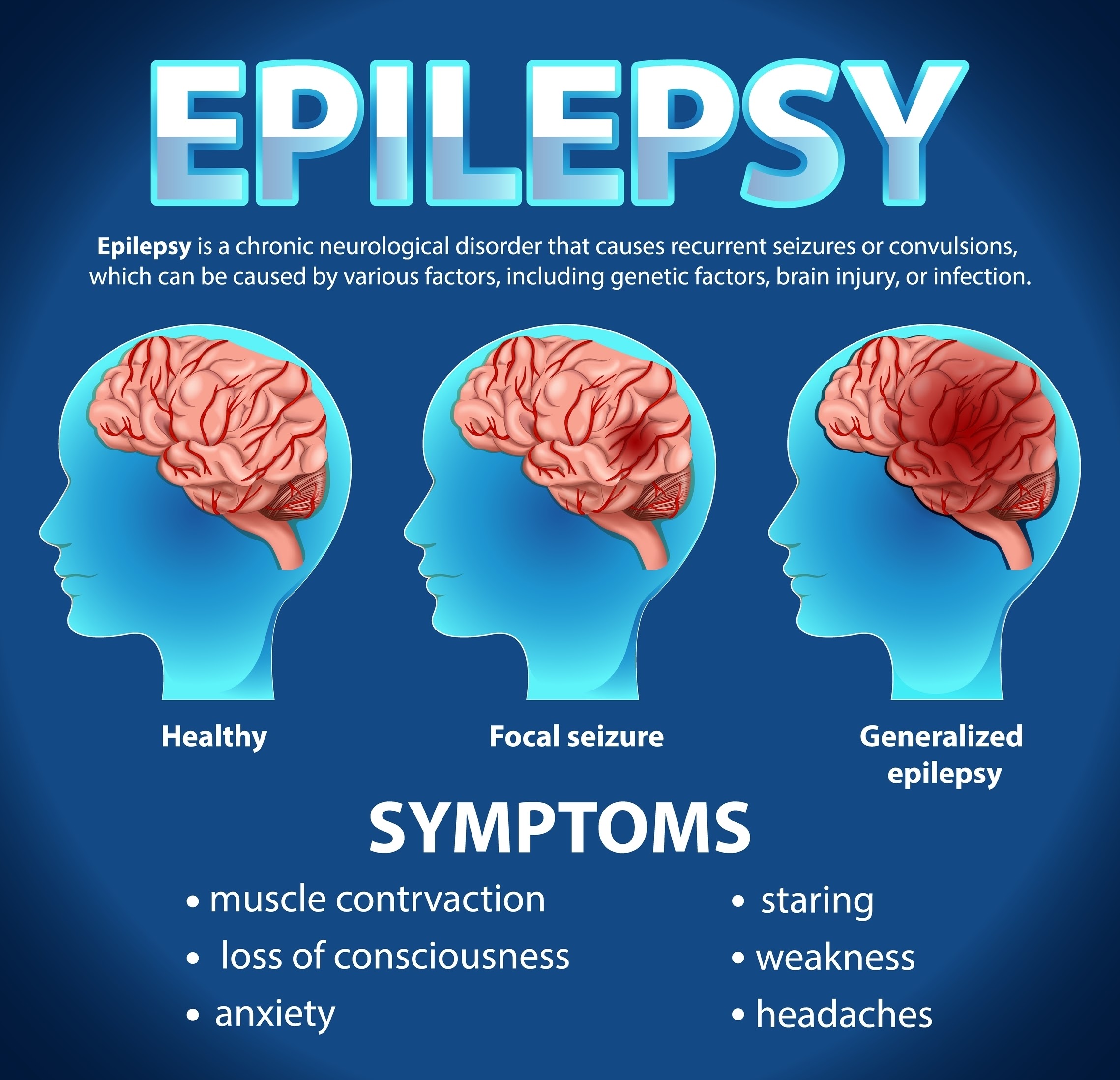 Photo Of Brain with Symptoms of Epilepsy